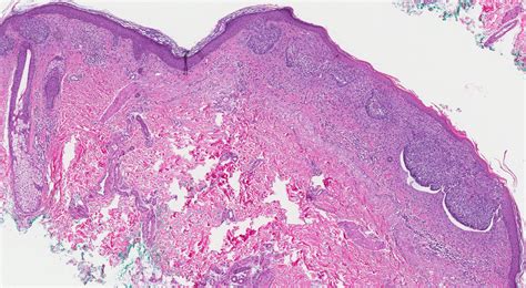 Carcinoma Basocelular Superficial Mypathologyreportca