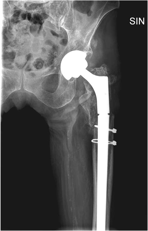 Diagnosis And Management Of Periprosthetic Femoral Fractures After Hip
