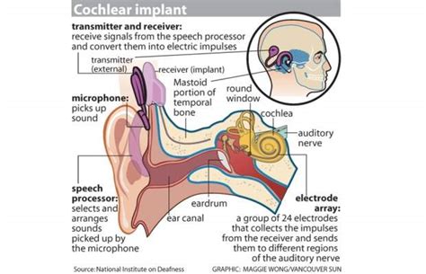 The Cochlear Implant Debate