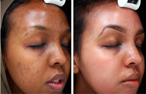Chemical Peel Guide Best Skincare And Skin Bleaching Products