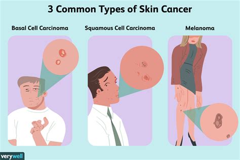 Stages Of Skin Cancer
