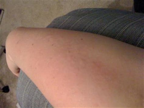 However, the little bumps may manifest as scaly, raised itchy bumps or dots on your legs. Little White Bumps Skin Rash on Arm