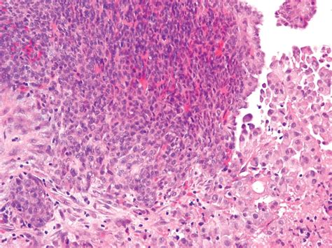 Epithelioid mesothelioma epithelioid mesothelioma is generally a disease of older adults with more than 90% of cases being diagnosed after the age of 50. Challenges and controversies in the diagnosis of malignant ...
