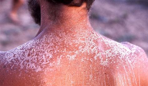 Home Remedies For Sunburn Suffer That Sting No More