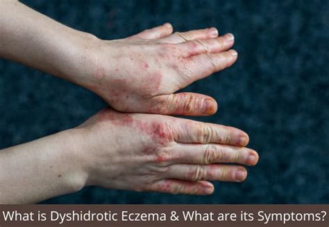 5 Signs That Your Blisters Are Actually Dyshidrotic Eczema Eczema