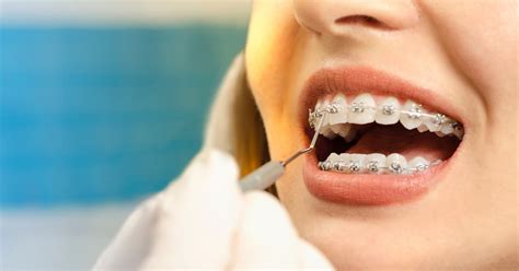 The Most Frequently Asked Questions About Braces Answered