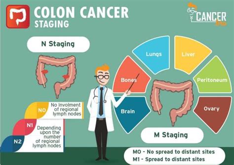 Colon Cancer Tnm Staging Explained Videos Infographic In Easy Way