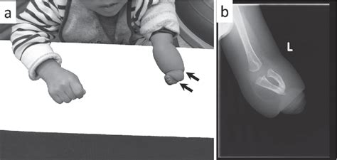 Figure 1 From Rehabilitation Approach For A Child With Cerebral Palsy