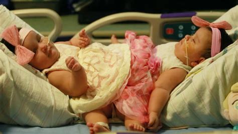 Conjoined Twin Girls Separated In Texas Surgery Cbs News