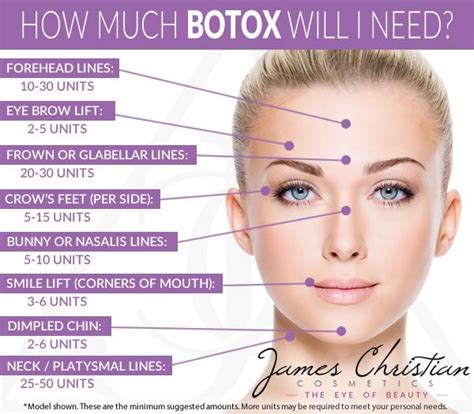 this handy infographic shows how much botox you might need for various facial areas if you live