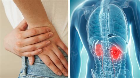 Kidney Cancer Warning Signs To Watch For As Half Of All Cases Have No