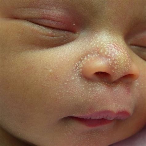 Yeast Infection Baby Neck Rash From Milk Idea Hostalelportalico
