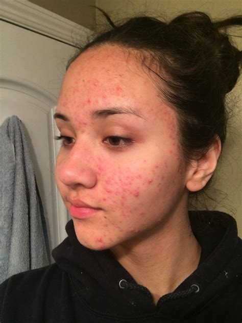 Banda One Year After Accutane Girl With Acne Acne Makeup Real Beauty