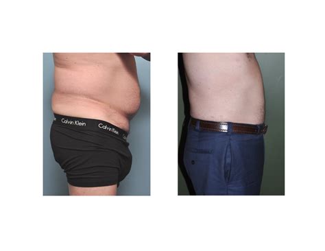 Case Study Liposuction Of The Male Stomach And Love Handles Explore