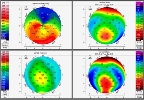 Whats In A Name Keratoconus Pellucid Marginal Degeneration And