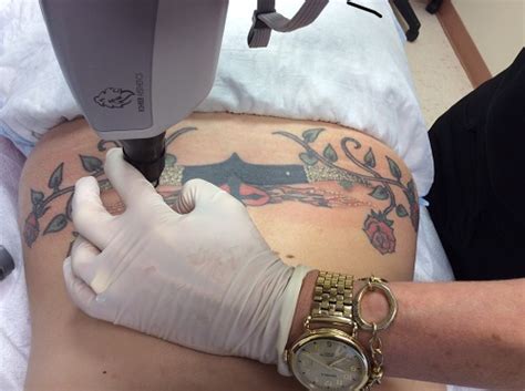 Laser tattoo removal in the clinic of aesthetic medicine. Tattoo Removal Before & After Photos | Lisa Bunin MD