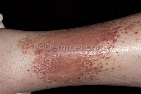 What Causes Eczema On Legs Dorothee Padraig South West Skin Health Care