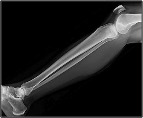 Clinical Anatomy Radiology Lateral Leg