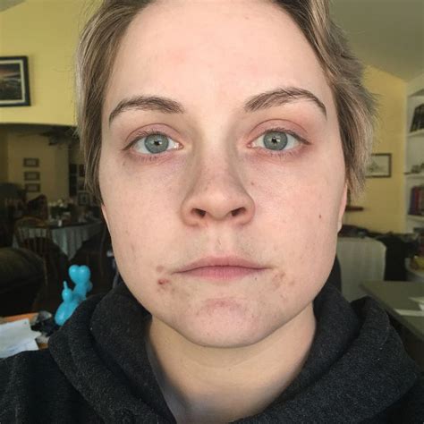 Skincarejourney I Developed Hormonal Acne After I Turned 22 I Only