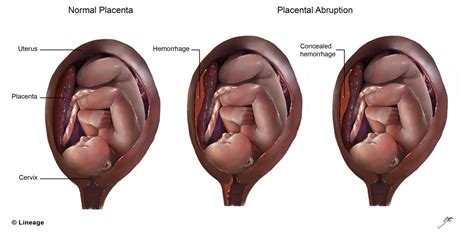 Postpartum Hemorrhage Obstetrics Medbullets Step 2 3