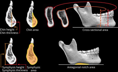 Measurements Of The Mandible Taken From Lateral And Cross Sectional