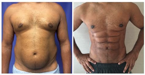 This Plastic Surgery Procedure That Promises To Give You Six Pack Abs Is Ridiculous