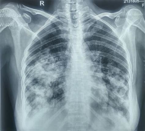 Chest X Ray Of Patient Showing Bilateral Nodular Opacities Found On The