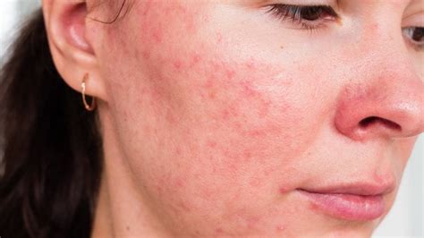 Rosacea Symptome Behandlung And Pflege