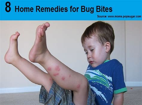 8 Home Remedies For Bug Bitesfor More Creative Tips And Ideas Follow