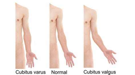 Cubitus Valgus Causes Symptoms Treatment Prevention More Healthroid