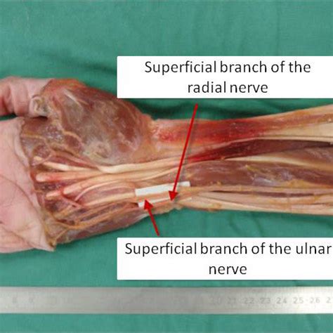 Transfer Of The Radial Branch Of The Superficial Radial Nerve To The