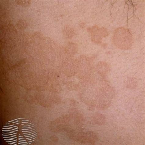 Tinea Versicolor Skin Rash Images And Photos Finder