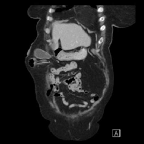 Sagittal View Ct Scan Of The Gallbladder In The Parastomal Hernia
