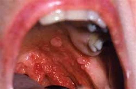 Squamous Cell Carcinoma Of The Tonsil Registered Dental Hygienists
