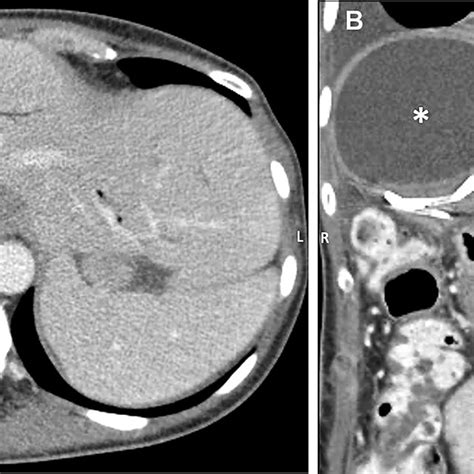 Contrast Enhanced Axial A And Coronal B Ct Scans Of The Abdomen In