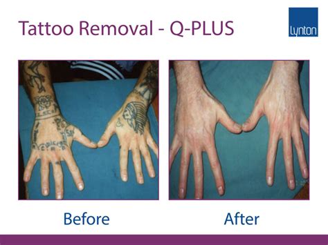 The Facts About Laser Tattoo Removal The Fab Clinic