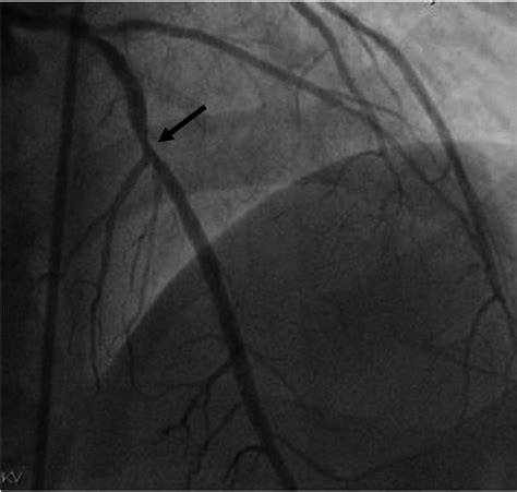 Vascular Restenosis In Coronary Artery Bypass Grafting Might Be My