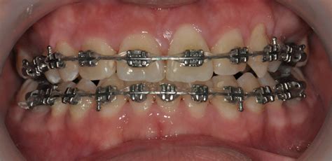 Power chains can be very similar to elastic ligatures. Orthodontic: A case with fix appliance 02 « Prestige ...