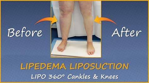 Lipedema Leg Liposuction Surgery Results Lipo 360° Legs Cankles