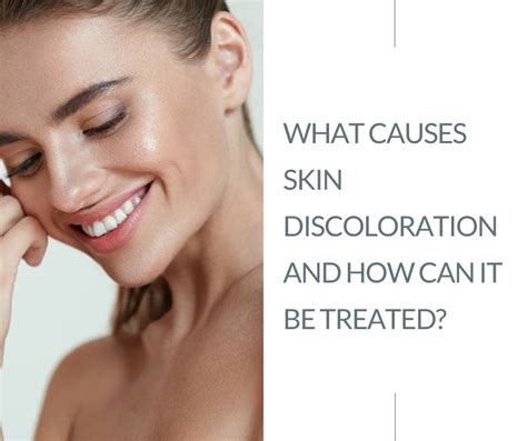 What Causes Skin Discoloration And How Can It Be Treated Astra Medicare