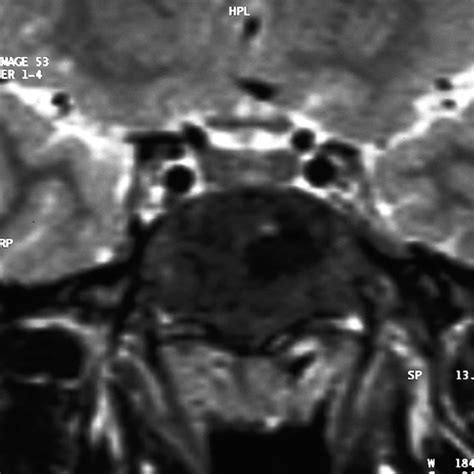 T1 Weighted Mri Scans Of The Lesion Showing Low Signal Intensity In The