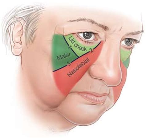 Figure From Surgical Anatomy Of The Midcheek Facial Layers Spaces