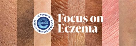 Eczema Awareness Month Events National Eczema Association