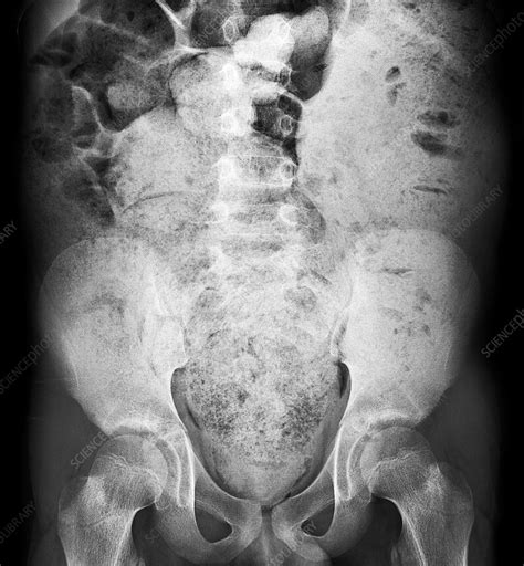 Bowel Obstruction X Ray Stock Image C0382434 Science Photo Library