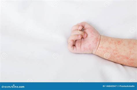 Hand Of Newborn Baby With Measles Rash On White Sheet Stock Image