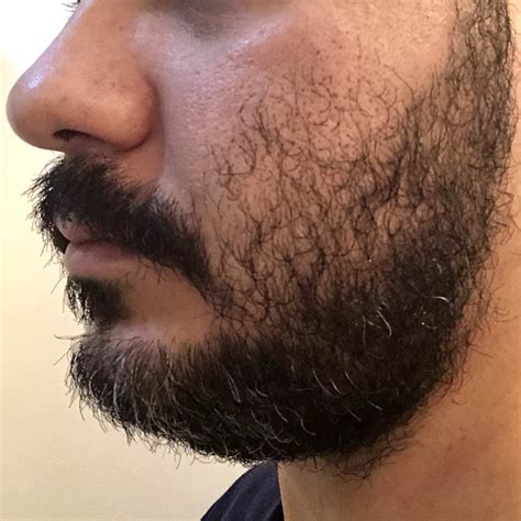 [week 6] Need Advice For My Cheeks Beards