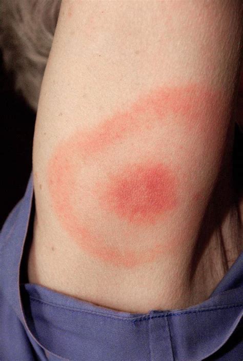 Chigger Bite Pictures Symptoms Treatment Home Remedies Prevention