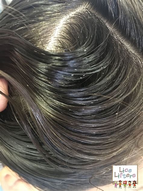 About the product color/type:dark brown/curly hair texture: Lice Removal Services Company | Lice Lifters