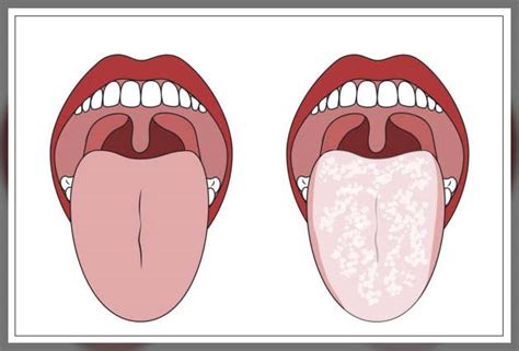 Geographic Tongue Causes And Treatment Repc
