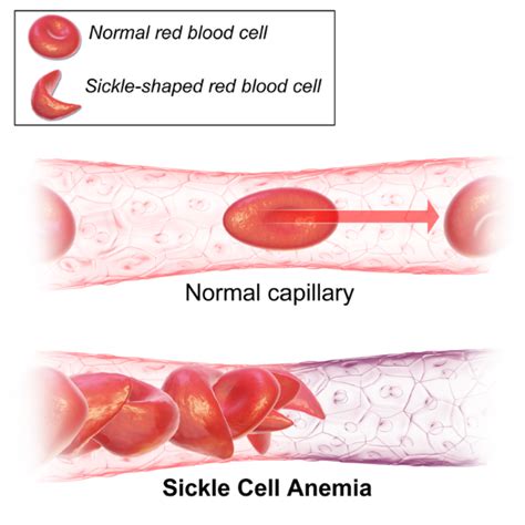 Sickle Cell Anemia Symptoms Genetics Disease Diagnosis And